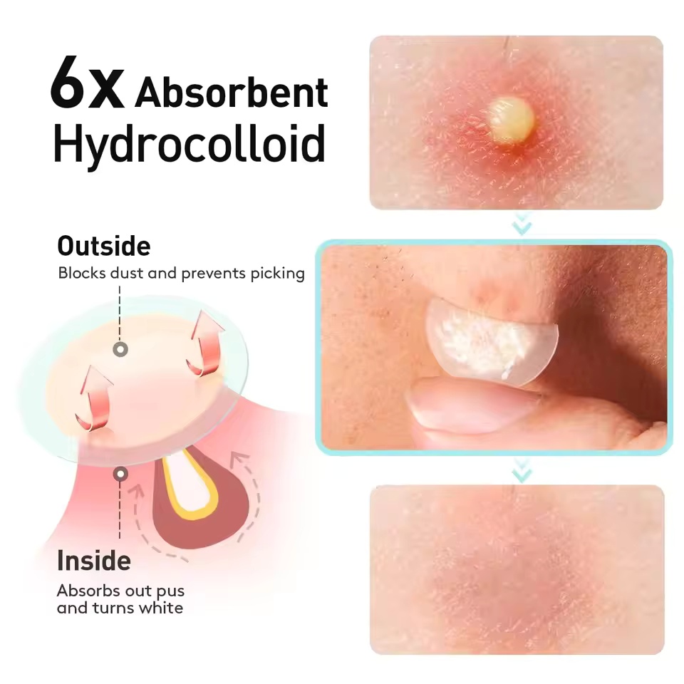 แผ่นแปะสิว 360 ชิ้น/กล่อง - ปร - Essential Oils บทวิจารณ์และราคา